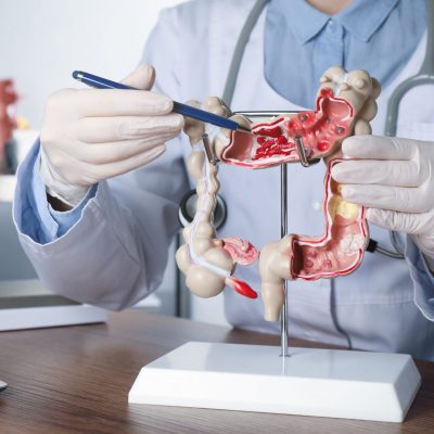 Gastroenterologist,Showing,Human,Colon,Model,At,Table,In,Clinic,,Closeup Gastroenterologist,Showing,Human,Colon,Model,At,Table,In,Clinic,,Closeup